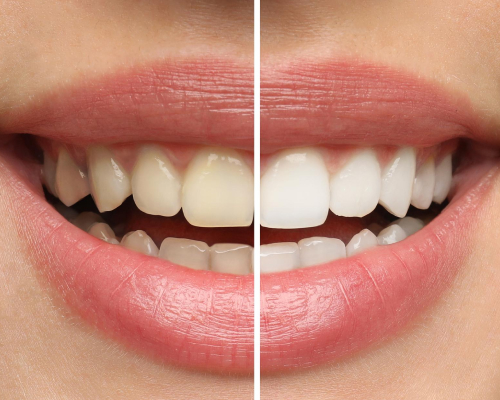 teeth whiting mobile