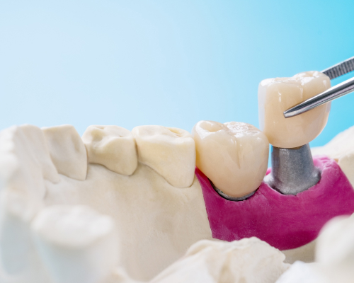 smiley-dental-fairhaven-crowns-mobile