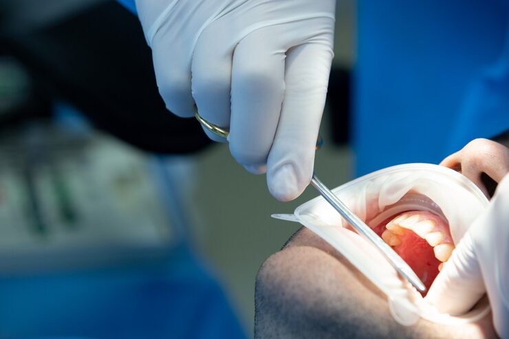 Surgical Dental Implant Placement